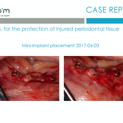 BlueM case report EN Dentalline 3 mini- implant 2017