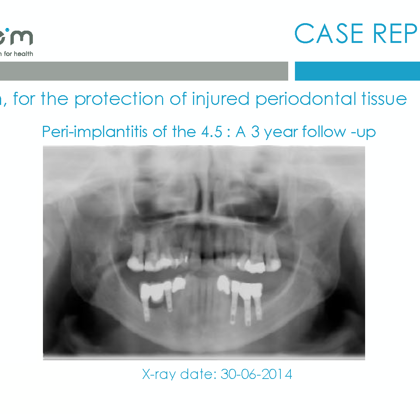 BlueM case report EN peri-implantitis of the 45 2017