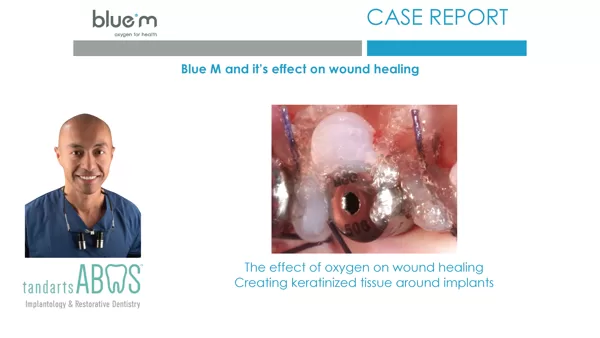 BlueM_case_report_EN_Abas_3_creating_keratinized_tissue_around_implants-_oral_gel_2017-1