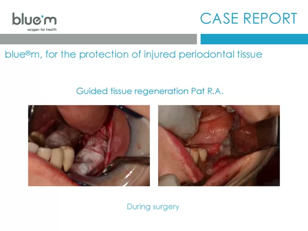 BlueM case report EN Dentalline 2 GTR oral gel 2017