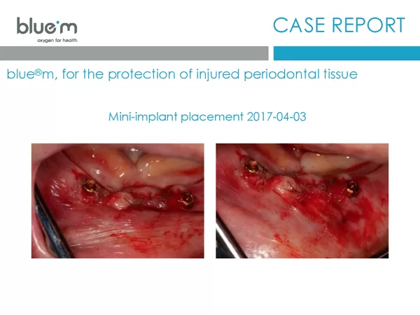 BlueM case report EN Dentalline 3 mini- implant 2017