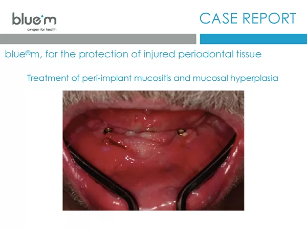 BlueM case report EN Dentalline 5 peri-implant mucositis- oral gel 2017 